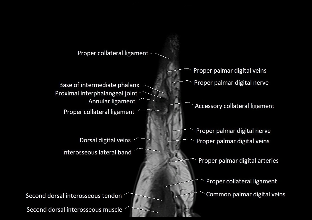 Finger anatomy sagittall cross section 3T image 2.webp